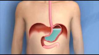 MGB Mini Gastric Bypass surgical procedure Animated version [upl. by Heisel]