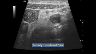 Mesenteric Vascular Occlusion  Ultrasound Case  GIT [upl. by Ihsakat453]