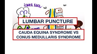 Lower back Anatomy Lumbar Puncture Cauda Equina Syndrome vs Conus Medullaris syndrome [upl. by Kathleen]