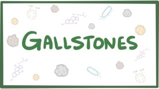 Gallstones cholelithiasis [upl. by Wolram]