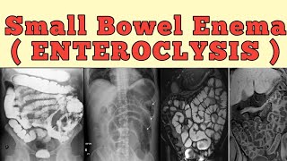 Small bowel enema  Enteroclysis [upl. by Perzan]