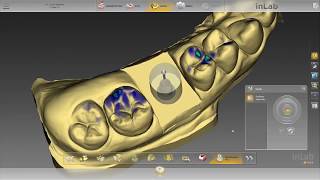 Digital Custom Abutment and Crown on Tibase Scan Body  Inlab Dentsply Sirona [upl. by Latsirhc]