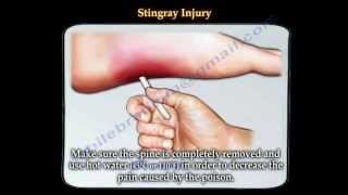 Stingray fish injury  Everything You Need To Know  Dr Nabil Ebraheim [upl. by Eduam]