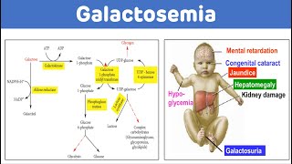 Galactosemia And Galactose Metabolism  Galactosemia Biochemistry [upl. by Eelinej]