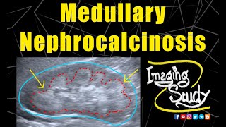 Medullary Nephrocalcinosis  Ultrasound  Case 128 [upl. by Isadore]