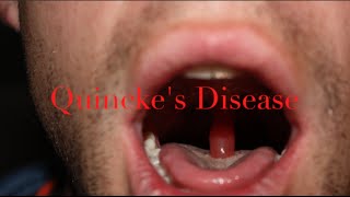 quinckes disease  medical minute [upl. by Oeramed39]