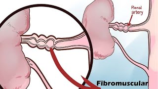 Renal Artery Stenosis [upl. by Ivar]