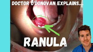 Explaining a Ranula or Mucocele  With Dr ODonovan [upl. by Llejk]