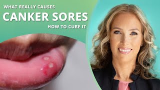 Canker Sores  How to Get Rid of Canker Sores  Dr J9 Live [upl. by Ellennod212]