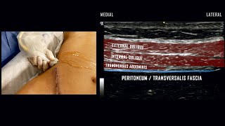 Transversus Abdominis Plane TAP Block  UltrasoundGuided Demonstration [upl. by Leribag]