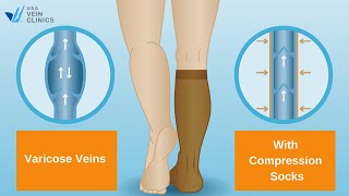 The Benefits of Vein Compression Socks [upl. by Selin]