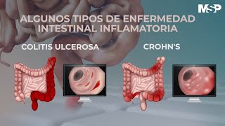 ¿Cómo tratar las enfermedades inflamatorias del intestino  ExclusivoMSP [upl. by Zachary]