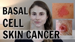 BASAL CELL SKIN CANCER WHAT YOU SHOULD KNOW DR DRAY [upl. by Isaacson]