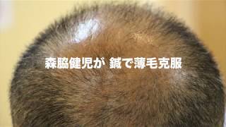 【森脇健児 鍼で薄毛を克服】ヘアロス解消！発毛・鍼灸・整体が得意な整骨院惠心堂へ [upl. by Nrubloc631]