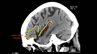 Introduction to Brain Surface Anatomy [upl. by Enyar771]