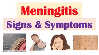 Meningitis Signs and Symptoms amp Why They Occur [upl. by Aisatal]