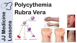 Polycythemia Rubra Vera  Pathophysiology Symptoms Diagnosis and Treatment [upl. by Adnarom127]