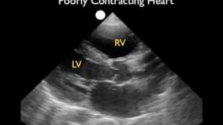 Cardiac Ultrasound  Parasternal Long Axis  Part 2  SonoSite Inc [upl. by Nolos872]