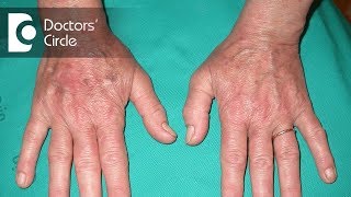 What is Lichen Planus and its clinical signs  Dr Satish DA [upl. by Alcock]