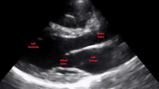 Echocardiogram Parasternal Long Axis View  Loop [upl. by Annwahsal]