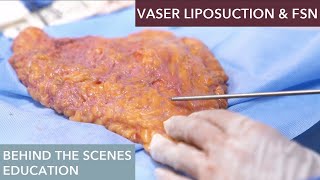 The Science Behind Vaser Liposuction How Does It Work [upl. by Seta335]