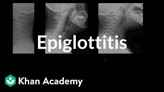 Epiglottitis diagnosis and treatment  Respiratory system diseases  NCLEXRN  Khan Academy [upl. by Farlee]