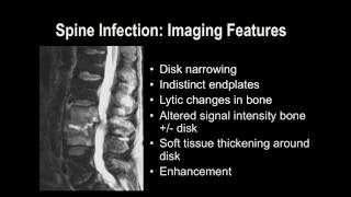 Understanding Basic MRI of the Spine [upl. by Nirtak320]