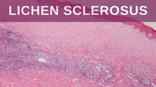 Lichen Sclerosus  Pathology mini tutorial [upl. by Ayotas256]