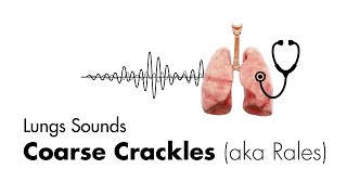 Coarse Crackles Rales  Lung Sounds  Medzcool [upl. by Hett]