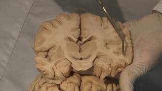 Cortical Localization Neuroanatomy Video Lab  Brain Dissections [upl. by Honeyman]