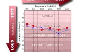 How to Read an Audiogram [upl. by Bollen]