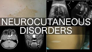 Neurocutaneous Disorders [upl. by Block]