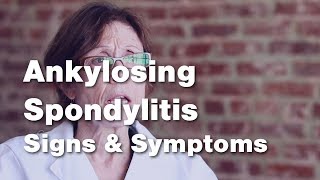 Ankylosing Spondylitis  Signs and Symptoms 2 of 5 [upl. by Ellersick47]