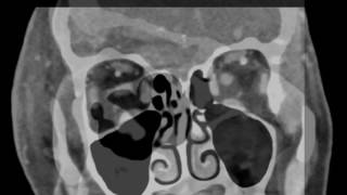 Periorbital Cellulitis [upl. by Lamberto]