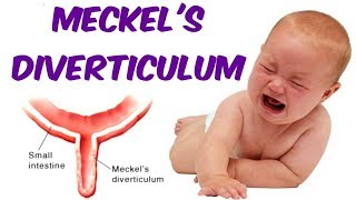 Meckels Diverticulum [upl. by Arral]