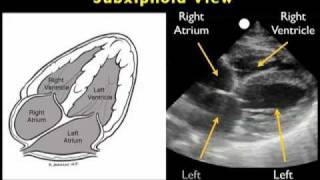 How to Echocardiography  Subxiphoid View [upl. by Graubert]