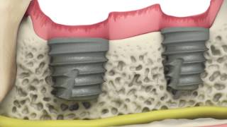 BioHorizons Tapered Short implants [upl. by Gratt]