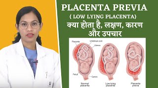 Placenta Previa FAQs By Dr Richa Vaishnav [upl. by Tager413]