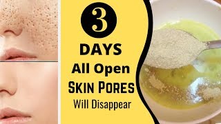 3 Days and All Open Pores Will Disappear from Your Skin Forever [upl. by Margret]