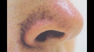 BEWARE LARGE PORES FROM PORE STRIPS [upl. by Dann]