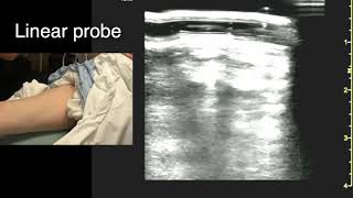 Ultrasound in the Femoral Triangle [upl. by Lrad]