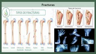 Generalidades de Traumatología Sil I Trauma y Ortopedia en Medicina en 1 2 x 3 [upl. by Gefell697]