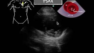 POCUS Cardiac PSAX Normal EF [upl. by Elleniad]