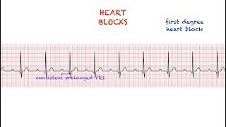 Heart Blocks Interpretation Easy and Simple [upl. by Nirrad]