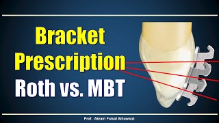 Using Roth and MBT brackets [upl. by Anikram]