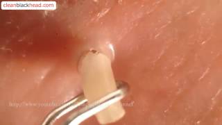 Blackhead Removal Tool  Popping Whiteheads and Blackheads Close Up [upl. by Ayekam]