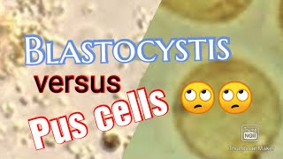 Skill Lab13 Blastocystis hominis versus pus cells [upl. by Jacintha662]