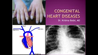 Congenital heart diseases [upl. by Lebasi]