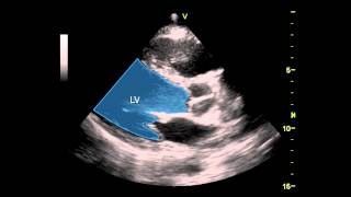 Parasternal Long Axis View [upl. by Casandra]