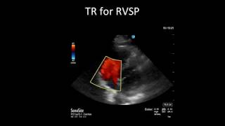 Principles of Doppler Ultrasound [upl. by Sehcaep353]